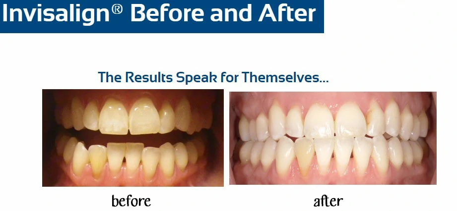 inv-before-after-e-rhodes