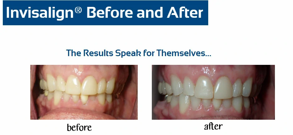 inv-before-after-g-erickson