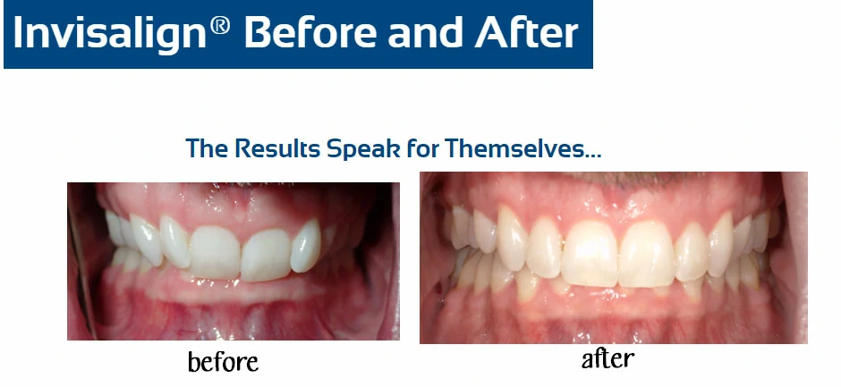 inv-before-after-g-fournier