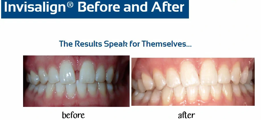 inv-before-after-g-lee