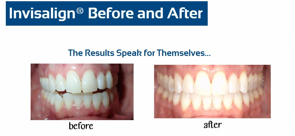 inv-before-after-j-daly