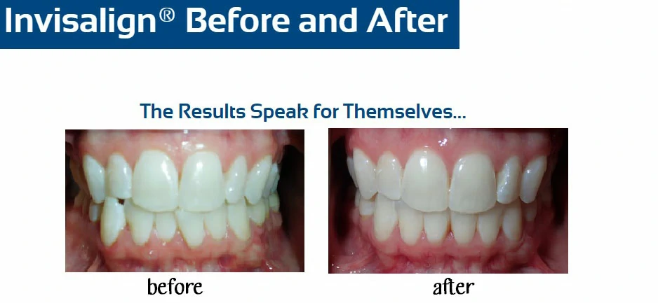 inv-before-after-j-pytlik