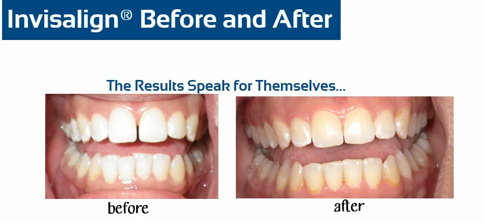 inv-before-after-k-flipse