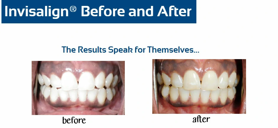 inv-before-after-l-fair