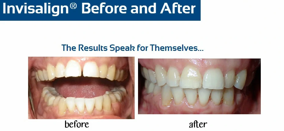 inv-before-after-l-neptune