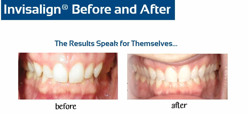 inv-before-after-m-gabriel