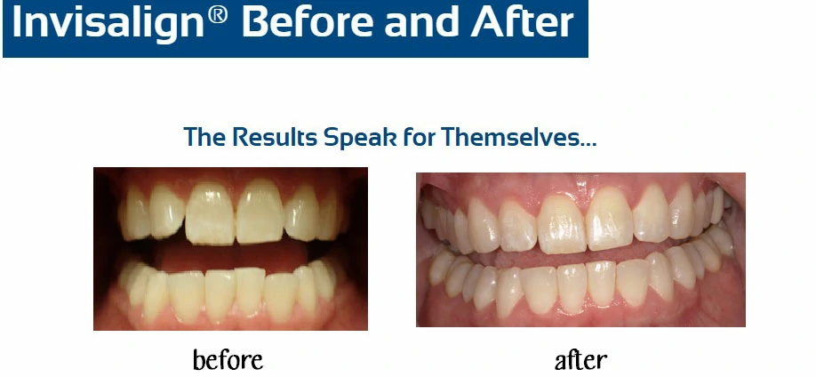 inv-before-after-m-hinds