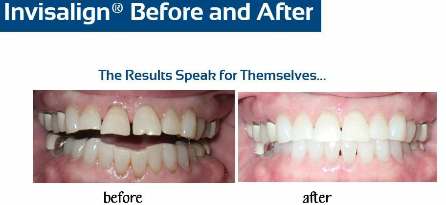 inv-before-after-m-nelson