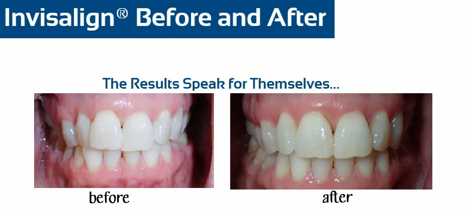 inv-before-after-p-hosack