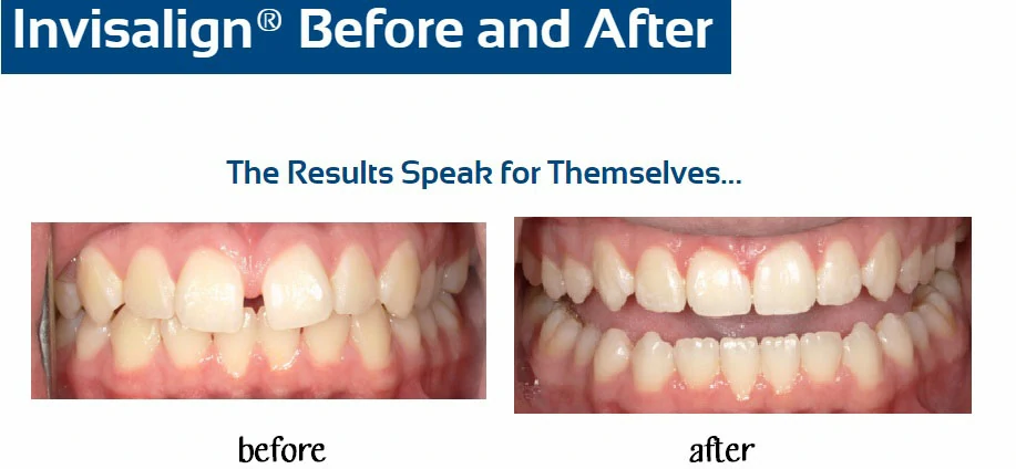 inv-before-after-r-hinds