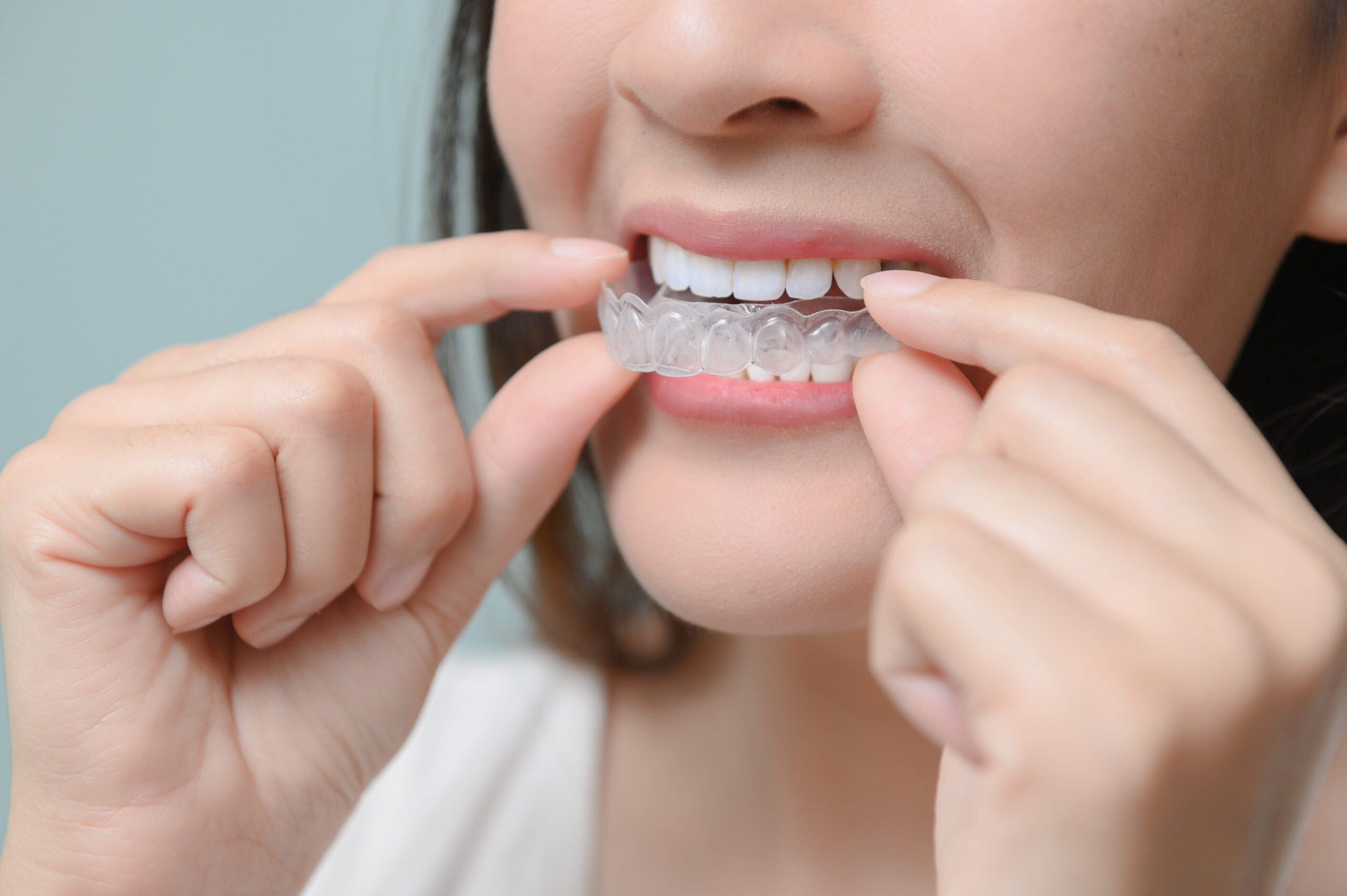 What Is an Overjet? How Invisalign Corrects This Common Bite Issue